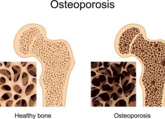 Home Remedies for Osteoporosis Treatment Naturally