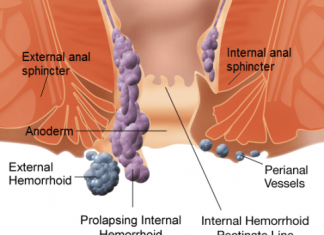 Home Remedies for Piles Hemorrhoids Treatment Naturally