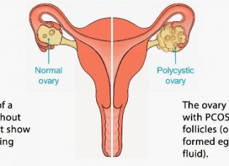 Home Remedies for Polycystic Ovary PCOS Treatment Naturally