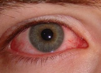 Home Remedies for Red Eye Treatment Naturally