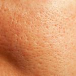 Home Remedies to Get Rid of Clogged Pores