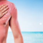 Home Remedies to Soothing Sunburn Treatments Naturally
