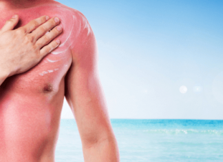 Home Remedies to Soothing Sunburn Treatments Naturally