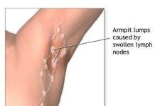 Home Remedies to Treat Armpit Lumps
