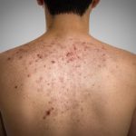 How to Get Rid of Bacne and Bacne Scars Natural Treatment