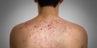 How to Get Rid of Bacne and Bacne Scars Natural Treatment