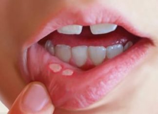 How to Get Rid of Canker Sores Home Remedies