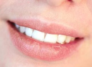 How to Get Rid of Chapped Lips Using Home Remedies