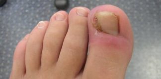 How to Get Rid of Ingrown Toenail at Home Yourself