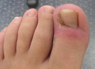 How to Get Rid of Ingrown Toenail at Home Yourself