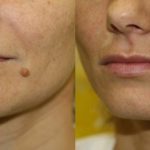 How to Get Rid of Moles Without Surgery