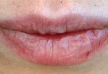 How to Get Rid of Painful Cracked Lips Fast and Naturally