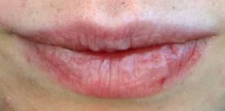 How to Get Rid of Painful Cracked Lips Fast and Naturally