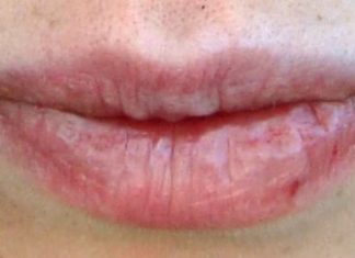 How to Get Rid of Painful Cracked Lips Fast and Naturally