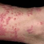 How to Get Rid of Poison Ivy Rashes Fast And Naturally