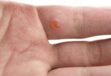 How to Get Rid of Warts on Hands Fingers Face