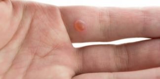How to Get Rid of Warts on Hands Fingers Face