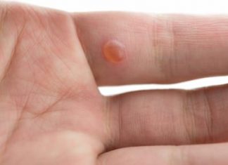 How to Get Rid of Warts on Hands Fingers Face