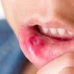 How to Treat Mouth Ulcers and Canker Sores
