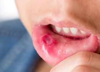 How to Treat Mouth Ulcers and Canker Sores