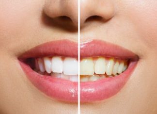 How to Use Hydrogen Peroxide to Whiten Teeth