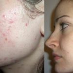 How to get rid of acne in 1 day