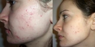 How to get rid of acne in 1 day