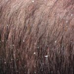 How to prevent and treat dandruff