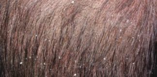 How to prevent and treat dandruff