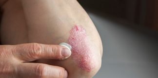 How to treat eczema naturally