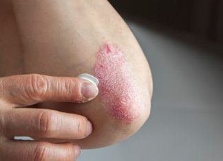 How to treat eczema naturally