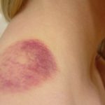 neck bruises - how to get rid of bruises on neck