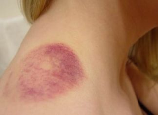 neck bruises - how to get rid of bruises on neck