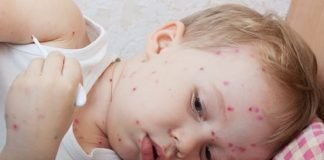 Home Remedies for Chicken Pox Relief Naturally