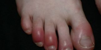 Home Remedies for Chilblains Treatment Naturally