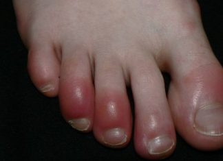Home Remedies for Chilblains Treatment Naturally