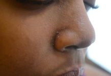 Home Remedies for Dry Nose Skin