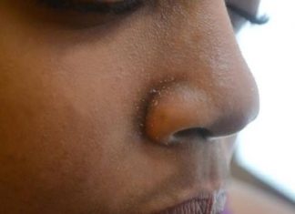 Home Remedies for Dry Nose Skin