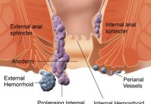 Home Remedies for Hemorrhoids Treatment at Home Treat Piles