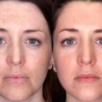Home Remedies for Melasma Treatment and Cure