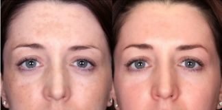 Home Remedies for Melasma Treatment and Cure