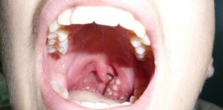 Home Remedies for Tonsillitis Treatment Sore Throat Treatment