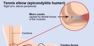 Home Remedies to Cure Tennis Elbow Naturally & Fast