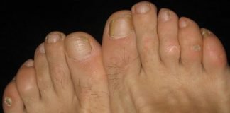 Home Remedies to Get Rid of Corns Corns Remedies