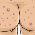 How to Cure Acne on Buttocks