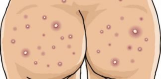 How to Cure Acne on Buttocks