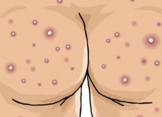 How to Cure Acne on Buttocks