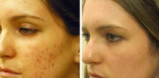 How to Get Rid of Acne Scars Naturally Without Chemicals