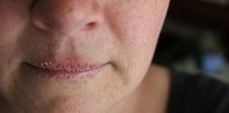 How to Get Rid of Chapped Lips Fast & Naturally