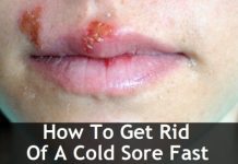 How to Get Rid of Cold Sore Fast